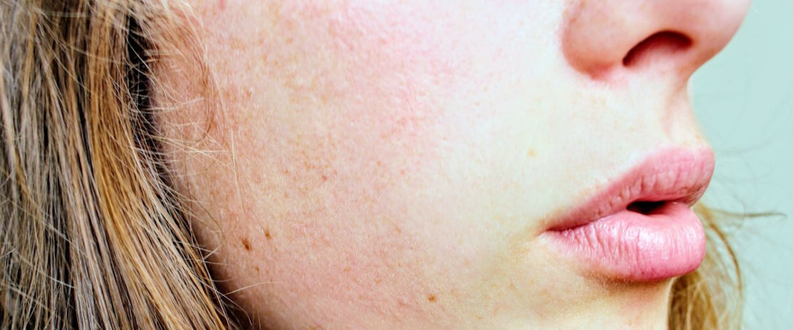 premature aging of the skin